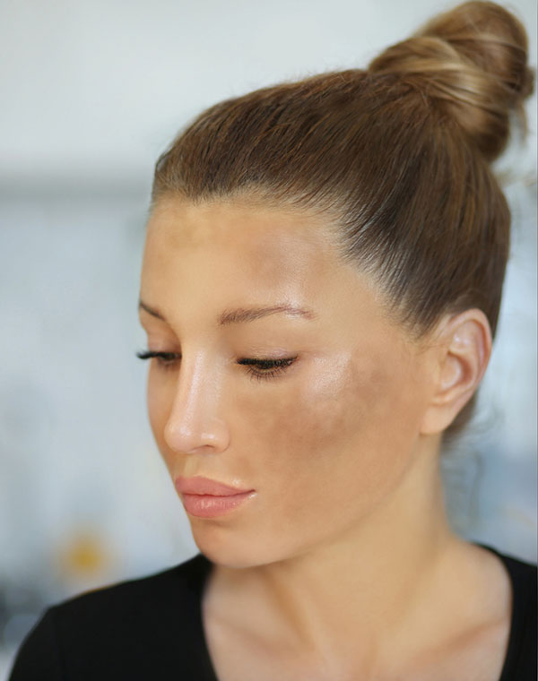 Eine Frau hat stärker pigmentierte Stellen auf Stirn und Wangen