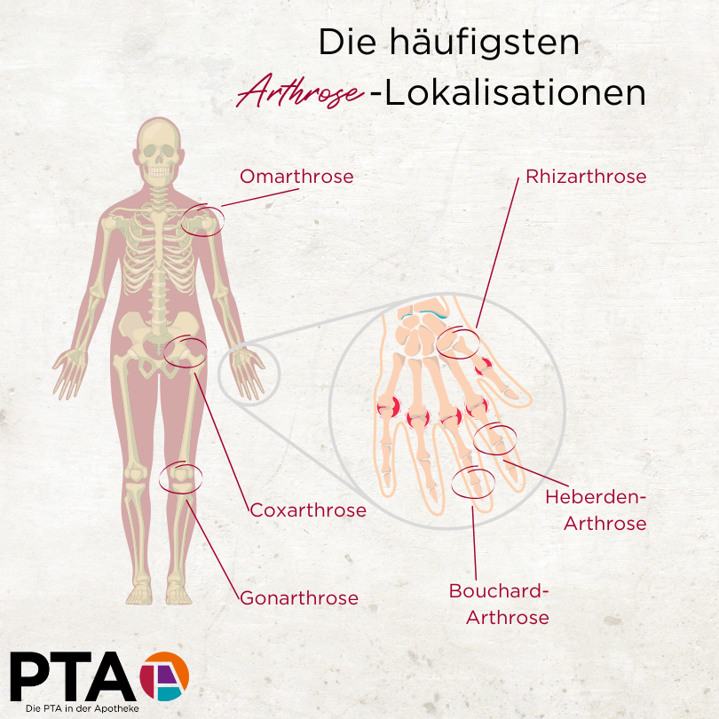 An einem Körper beziehungsweise vergrößert an einer Hand sind die häufigsten Arthrose-Lokalisationen eingekreist: Omarthrose, Coxarthrose, Gonarthrose und an der Hand Rhizarthrose, Heberden-Arthrose und Bouchard-Arthrose.