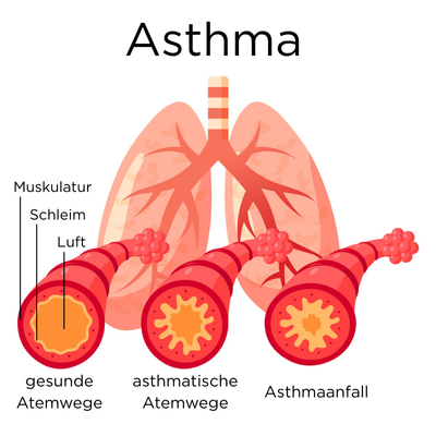 Schaubild zeigt drei Querschnitte der Atemwege: Bei der gesunden Lunge sind die Muskeln entspannt und die Schleimschicht ist dünn, sodass viel Raum für die Luft zum Durchströmen bleibt. In der asthmatischen Lunge sind die Muskeln angespannt und verdickt, auch die Schleimschicht ist dicker, sodass weniger Raum für die Luft im Inneren der Atemwege bleibt. Noch extremer ist dies beim Asthmaanfall. 
