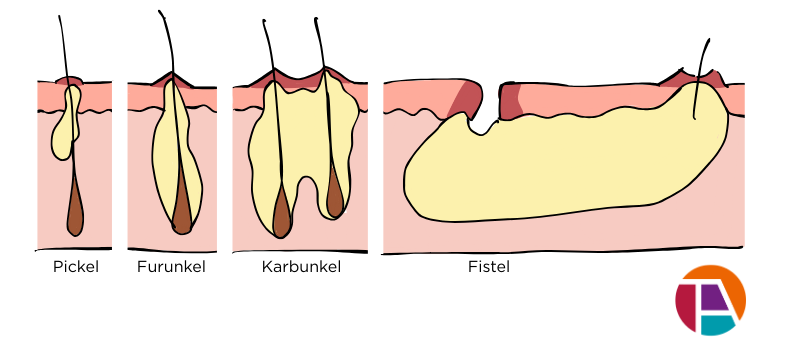 Ein Schaubild zeigt einen Pickel, ein Furunkel, ein Karbunkel und eine Fistel.