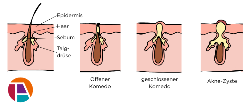 Ein Schaubild zeigt verschiedene Formen unreiner Haut.
