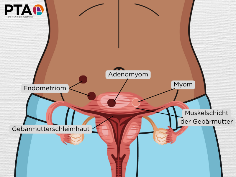 Eine Illustration der Gebärmutter vor dem weiblichen Körper: Endometriom, Adenomyom und Myom sind wie beschrieben eingezeichnet, Gebärmutterschleimhaut und Muskelschicht der Gebärmutter sind gekennzeichnet.