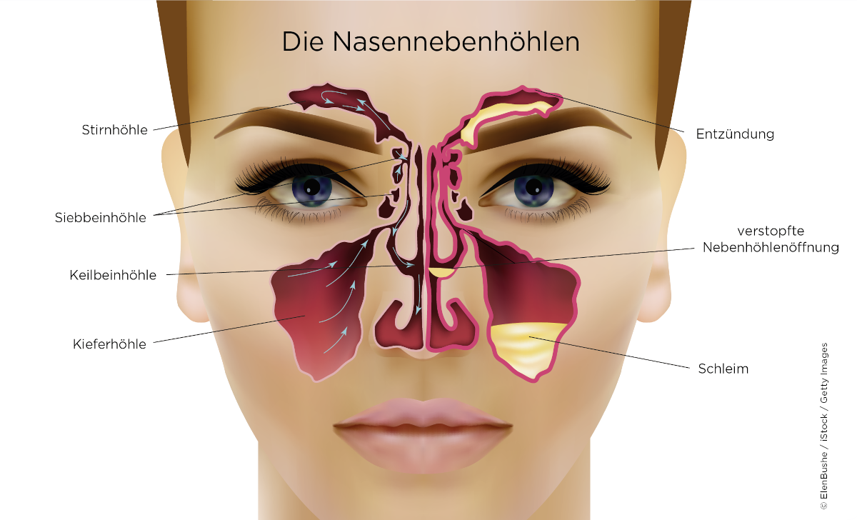 Illustration eines Gesichts mit Rhinosinusitis, die Stirn- und Nasennebenhöhlen sind dargestellt und erkennbar entzündet.