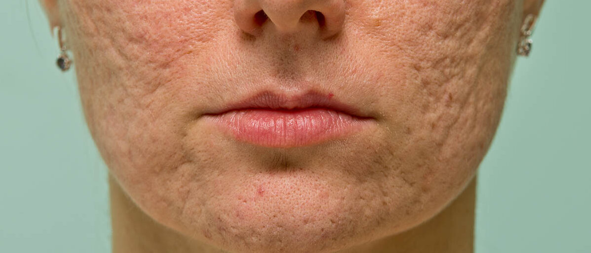 Kinnpartie einer Frau: Sie hat viele, tiefe Akne-Narben.