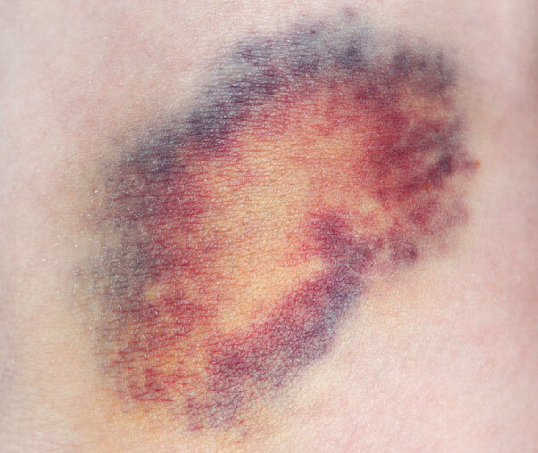 Ein blauer Fleck: Außen violett, innen gelb