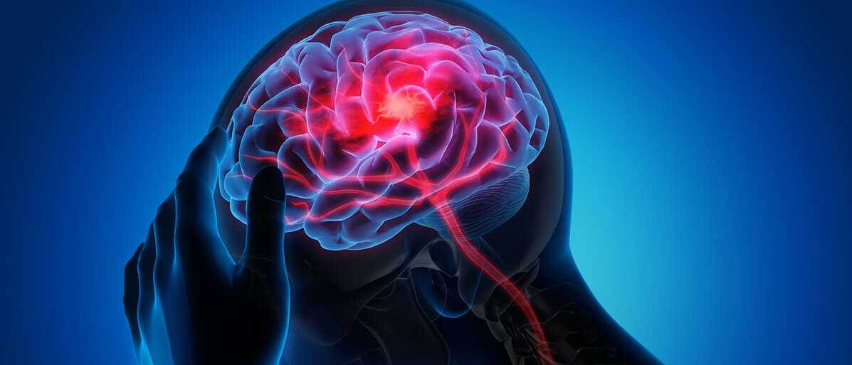 Darstellung eines männlichen Kopfes. Im Gehirn rot dargestellt ein Gerinsel