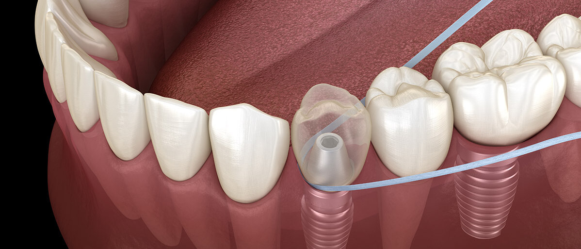 3D-Illustration: Reinigung eines Zahnimplantats mit Zahnseite