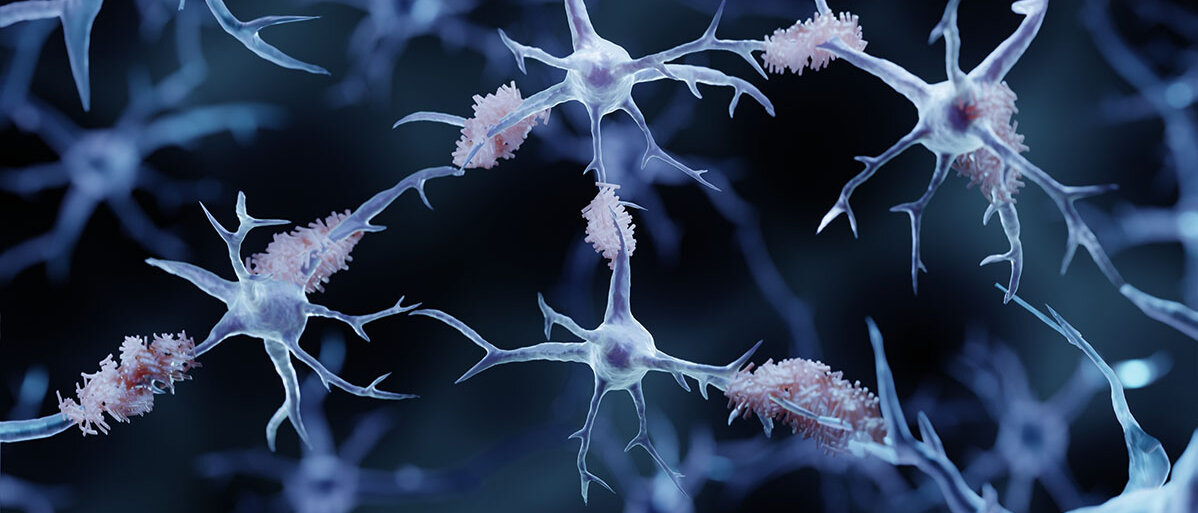 3D-Illustration von Nervenzellen, um die sich weitere Strukturen ansammeln.
