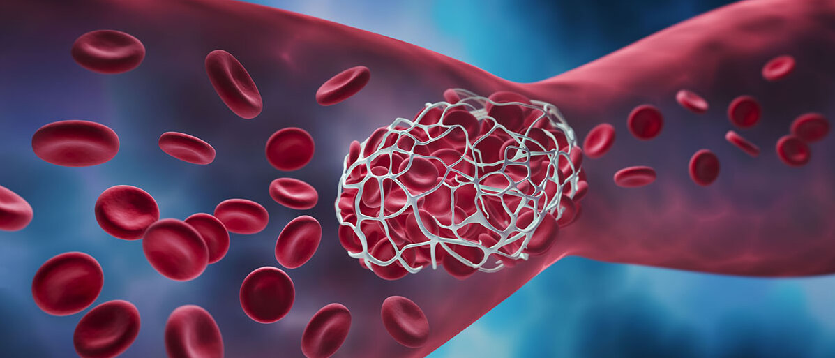 Ein Blutgerinnsel blockiert ein Blutgefäß.