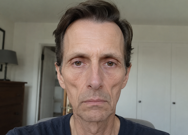 Ozempic Face: Nebenwirkungen der Abnehmspritze im Gesicht Ein Mann mit eingefallenem Gesicht: Die Wangen treten deutlich hervor, die Haut hängt im Kinnbereich und die Augen liegen tief.