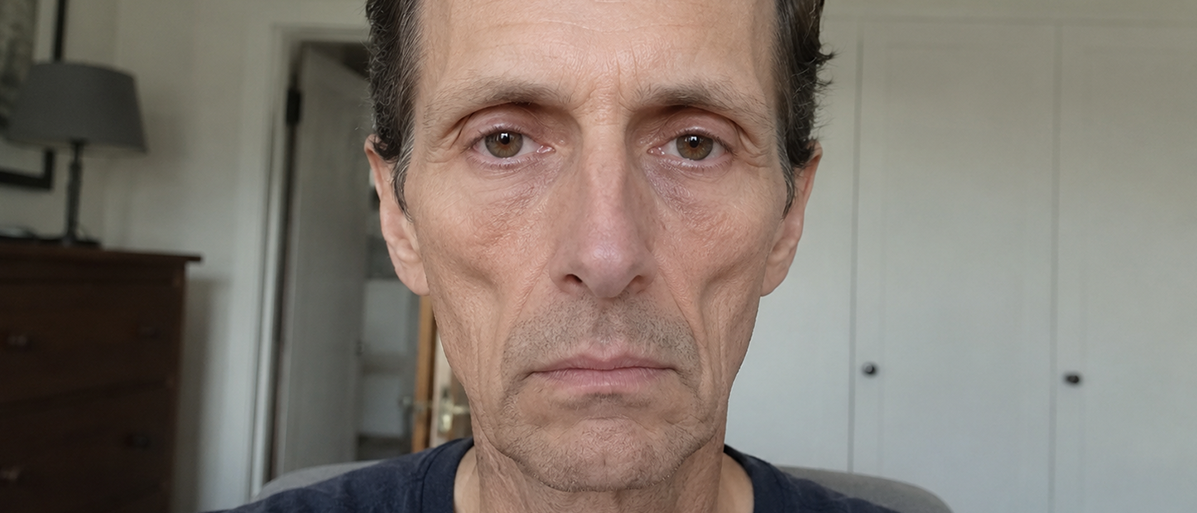 Ozempic Face: Nebenwirkungen der Abnehmspritze im Gesicht Ein Mann mit eingefallenem Gesicht: Die Wangen treten deutlich hervor, die Haut hÀngt im Kinnbereich und die Augen liegen tief.