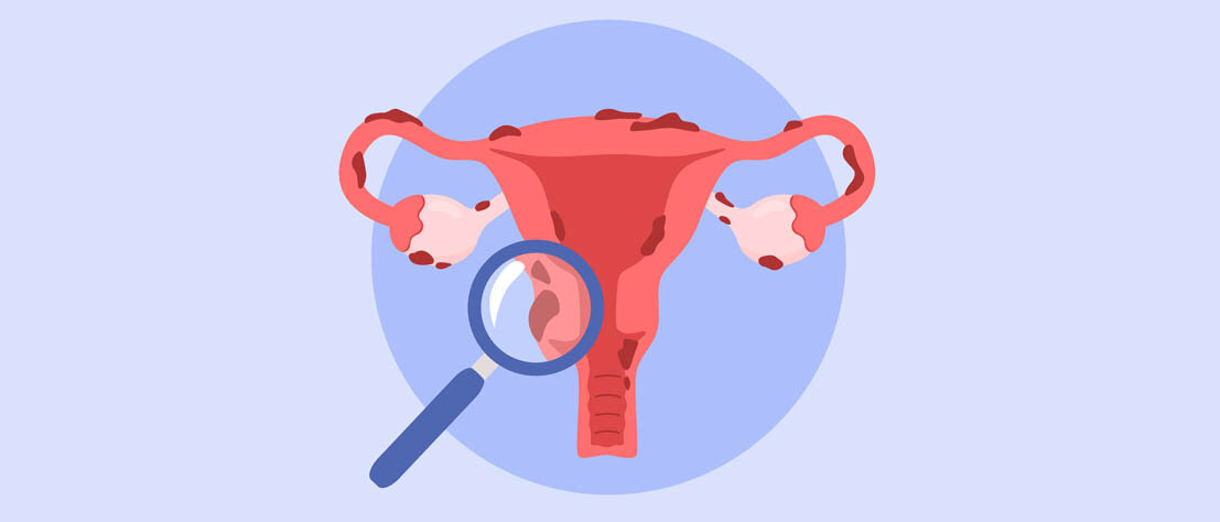 Illustration einer Gebärmutter, Vagina, Eileiter und Eierstöcke: Sowohl in der Gebärmutter als auch an den Eileitern, Eierstöcken und außen an der Gebärmutter sind dunkelrot Endometrioseherde.