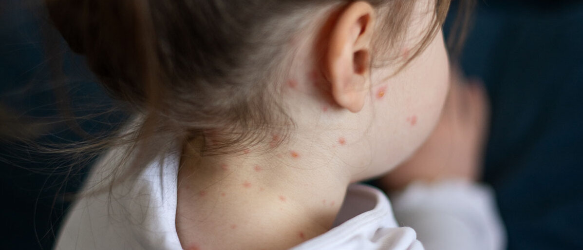Nahaufnahme eines Kindes mit Masern am Kopf