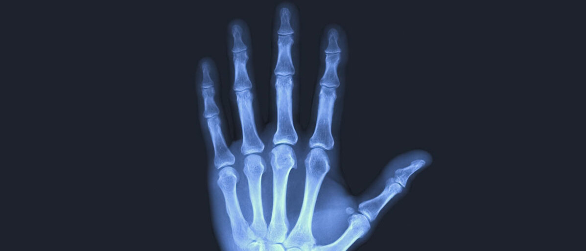 Röntgenhand auf schwarzem Hintergrund