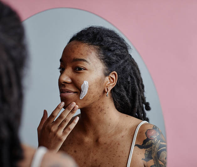 Eine Frau mit Akne steht vor dem Spiegel und trägt eine Creme auf ihre Wange auf.