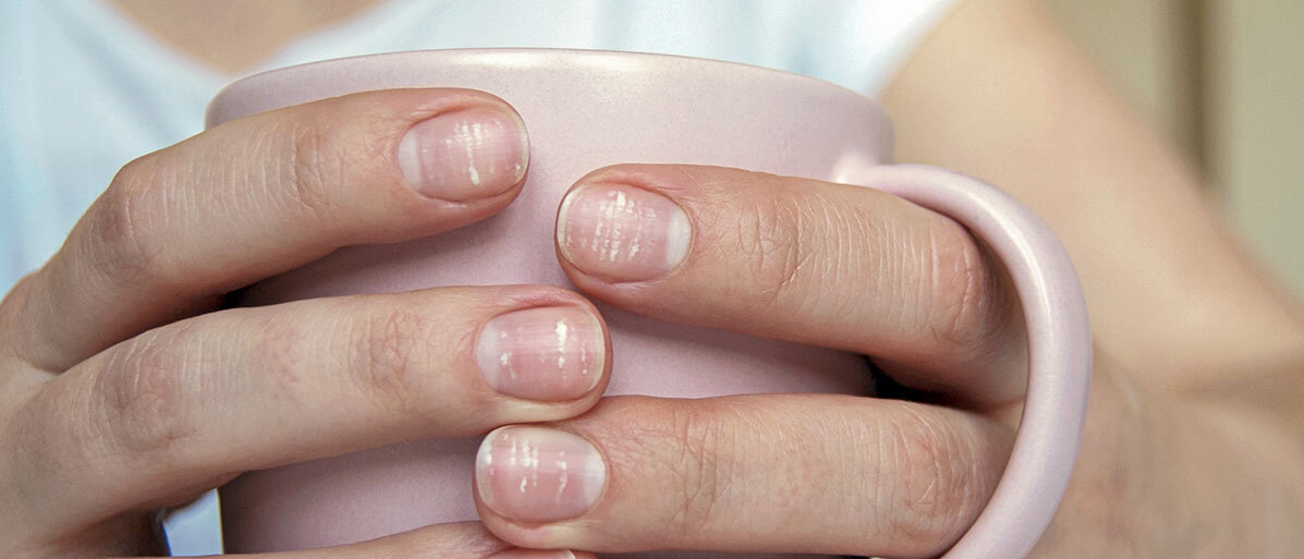 Eine Frau umfasst eine Tasse, sodass wir ihre Nägel sehen. Jeder Fingernagel hat mehrere weiße Flecken.