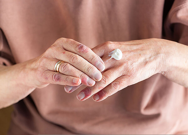 Atopisches Ekzem Frau mit Neurodermitis cremt sich die Hände ein