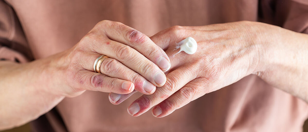 Atopisches Ekzem Frau mit Neurodermitis cremt sich die Hände ein