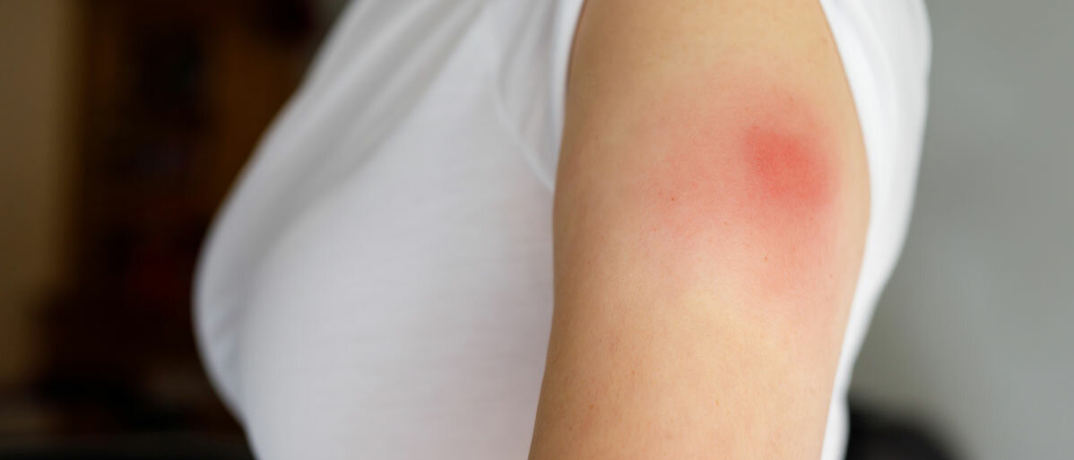 Eine Frau hat den Ärmel hochgekrempelt, an ihrem Oberarm ist eine rötliche, erhabene Schwellung, wohl von einer Impfung.