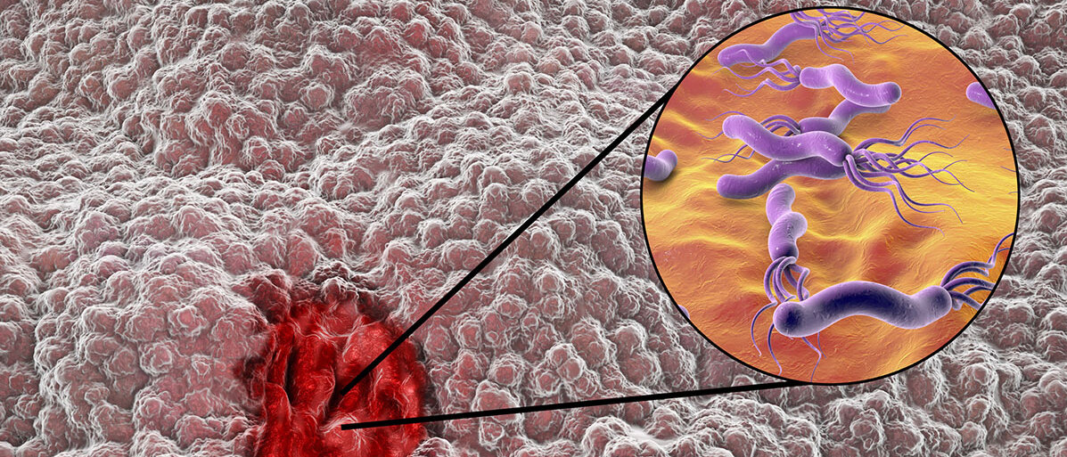 Magenschleimhaut und ein roter Kreis soll ein Magengeschwuer darstellen. Rechts oben in einem gesonderten Kreis ist das Bakerium Helicabakter pylori abgebildet