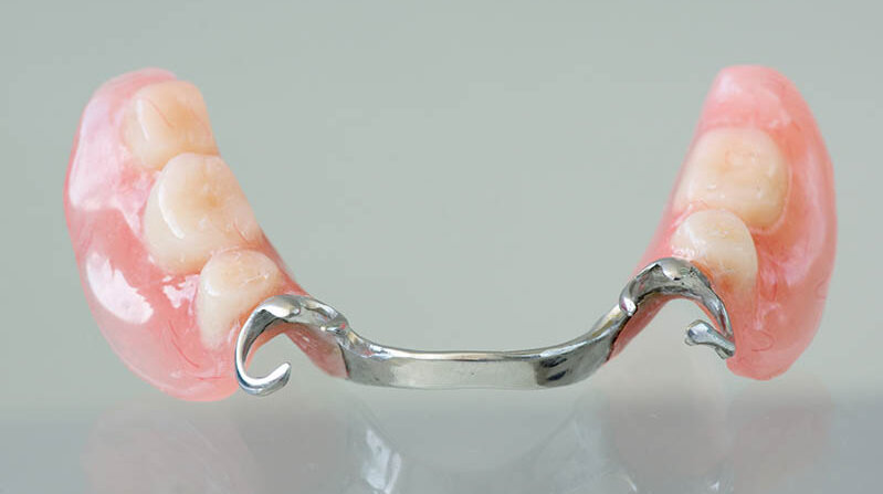 Eine Zahnprothese: Auf der einen Seite sind drei Backenzähne, auf der anderen zwei, und verbunden sind die Seiten über ein Metallstück.