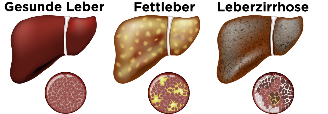 Grafik mit drei Lebern und jeweils dazugehörigem Gewebsschnitt: Die gesunde Leber ist besteht aus vielen kleinen, braunen Zellen. Bei der Fettleber sind einige Zellen vergrößert und gelbe Schichten befinden sich zwischen diesen Zellen. Bei der Leberzirrhose sind auch große dunkle und große graue Zellen zwischen den braunen Zellen, die braunen Zellen machen nicht einmal mehr die Hälfte aus.
