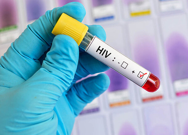 HIV-positive Blutprobe