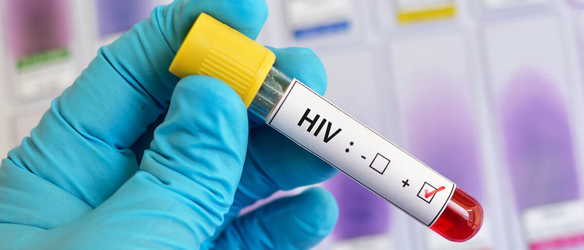 HIV-Medikamente können die Infektion nicht heilen, aber Aids unterdrĂŒcken. HIV-positive Blutprobe