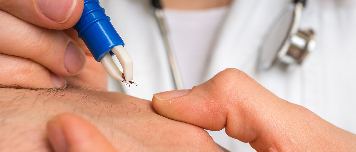 Arzt entfernt Zecke mit Pinzette aus der Haut eines Patienten.