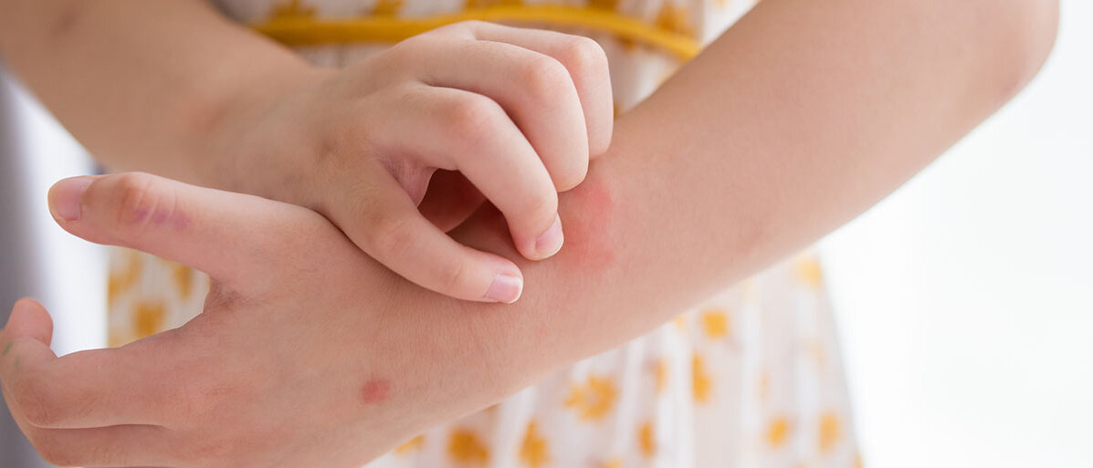 Kleines Mädchen hat einen Hautausschlag am Arm und kratzt sich.