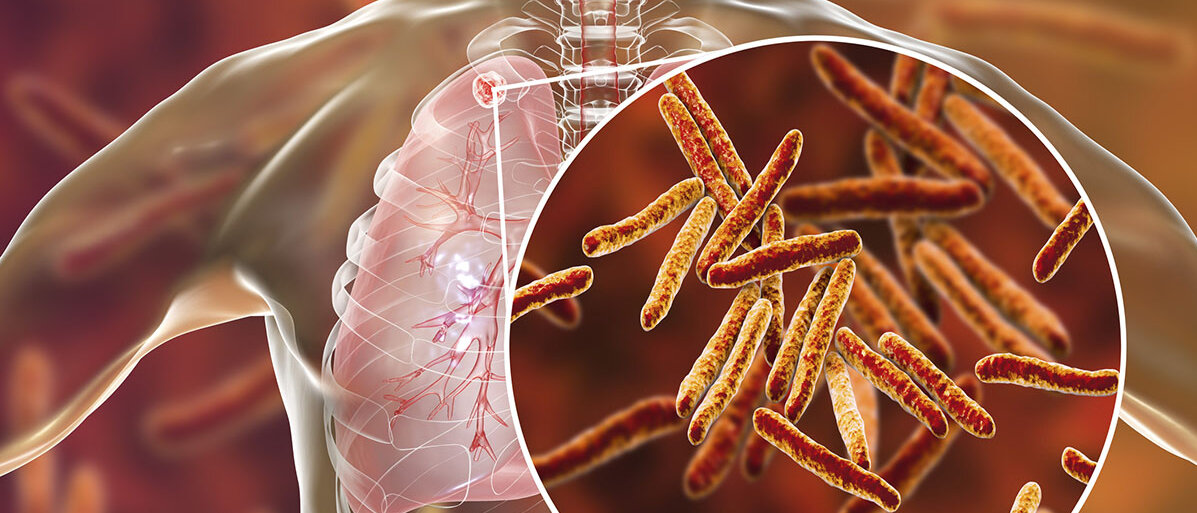 3D-Illustration: Tuberkulose in der Lunge und Nahaufnahme von Mycobacterium tuberculosis-Bakterien.