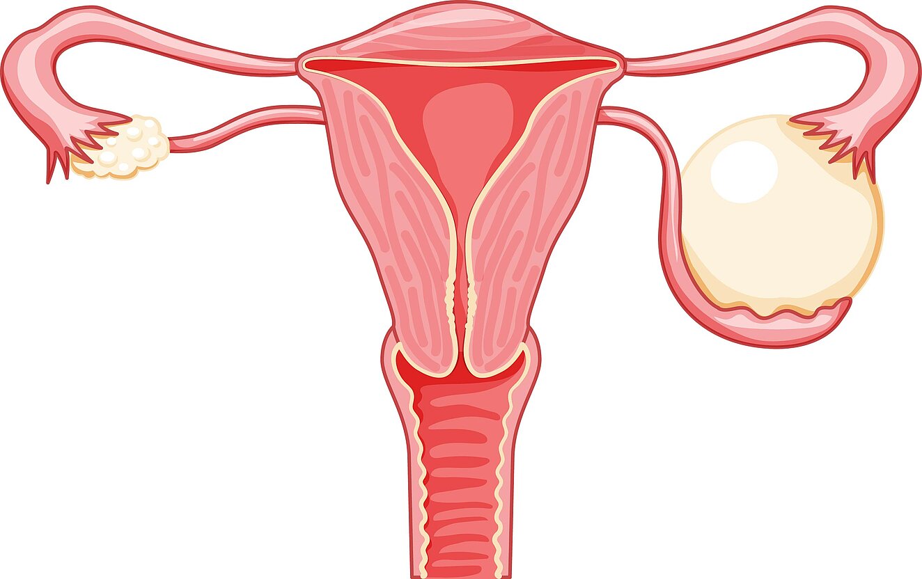 Grafik des Uterus mit Eierstöcken und Vagina: Der Gebärmutterhals ist eingekreist. Darunter ist die Ansicht auf den Gebärmutterhals durch das Spekulum: Ein Kreis mit einer kleinen Öffnung in der Mitte. Links ist der Kreis rosa und mit “normal” gekennzeichne”, rechts hat er ungleichmäßige, andersfarbige Beläge und ist mit “abnormal” gekennzeichnet.