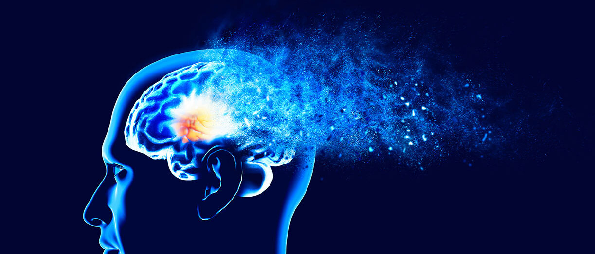 Alzheimer-Therapie mit Donanemab Graphische Darstellung eines Gehirns aus der Seitenansicht.