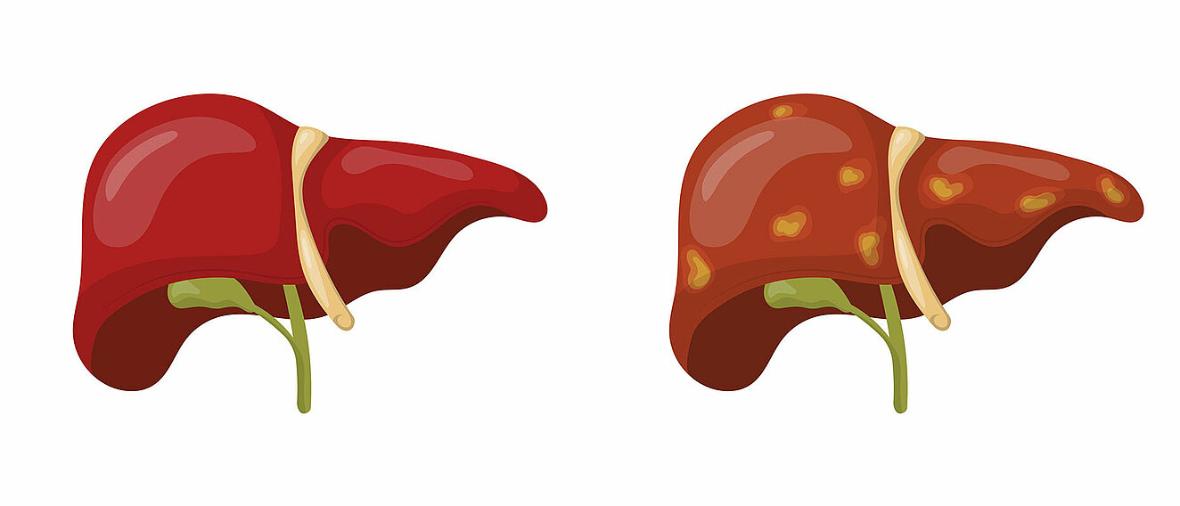 Darstellung einer gesunden Leber und deiner Fettleber
