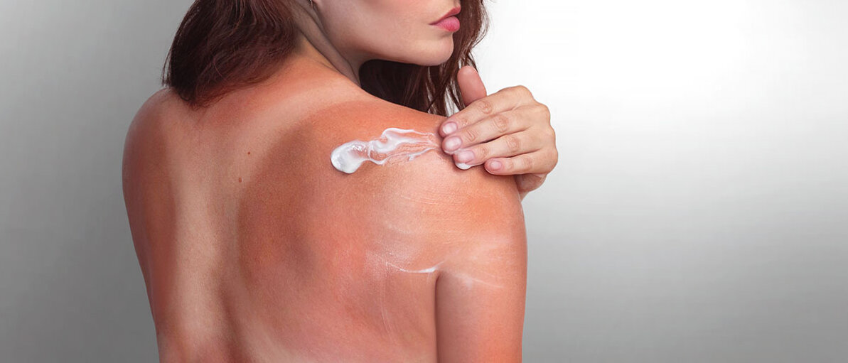 Tanmaxxing Frau mit Sonnenbrand von hinten trÀgt Creme an Schulter auf.
