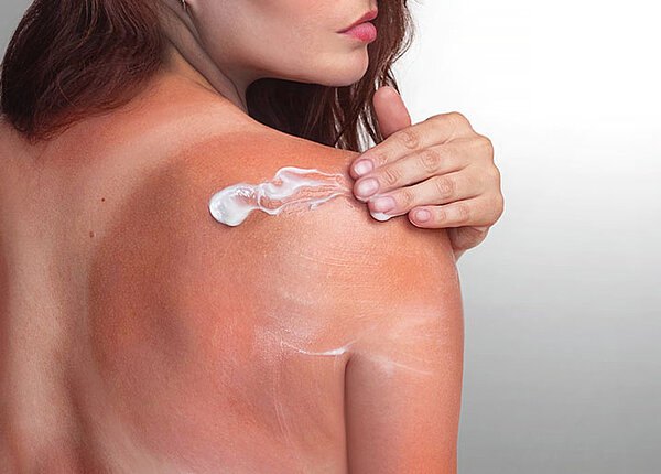 Tanmaxxing Frau mit Sonnenbrand von hinten trägt Creme an Schulter auf.