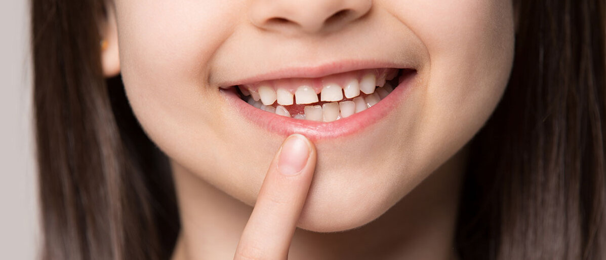 Ein Mädchen lächelt und zeigt mit dem Finger auf ihre Zahnlücke, in der bereits ein neuer Zahn zu sehen ist.