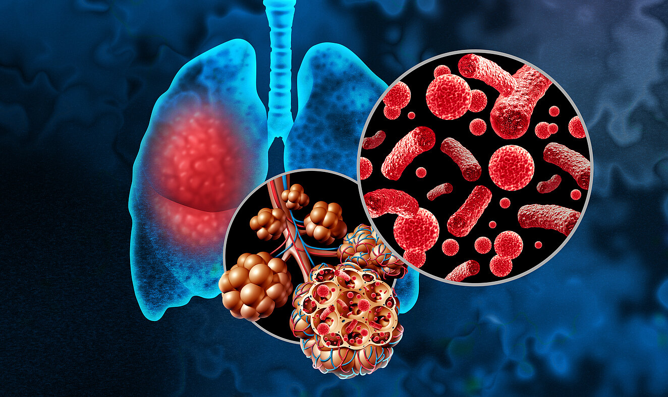 Illustration einer Lunge. Ein Lungenflügel ist stellenweise rot eingefärbt. Vergrößert sehen wir die Lungenbläschen und in einer weiteren Vergrößerung Keime, die sich in den Lungenbläschen befinden.