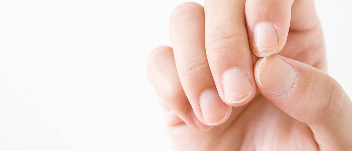 Brüchige Fingernägel: An den Spitzen sieht man, dass die oberen Schichten der Nagelplatte sich abheben oder abgesplittert sind.