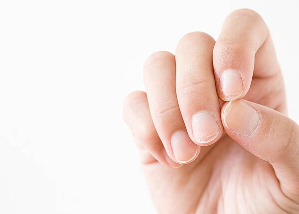 Brüchige Fingernägel: An den Spitzen sieht man, dass die oberen Schichten der Nagelplatte sich abheben oder abgesplittert sind.