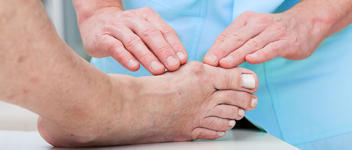 Hallux valgus Fuß mit Hallux valgus während ärztlicher Untersuchung