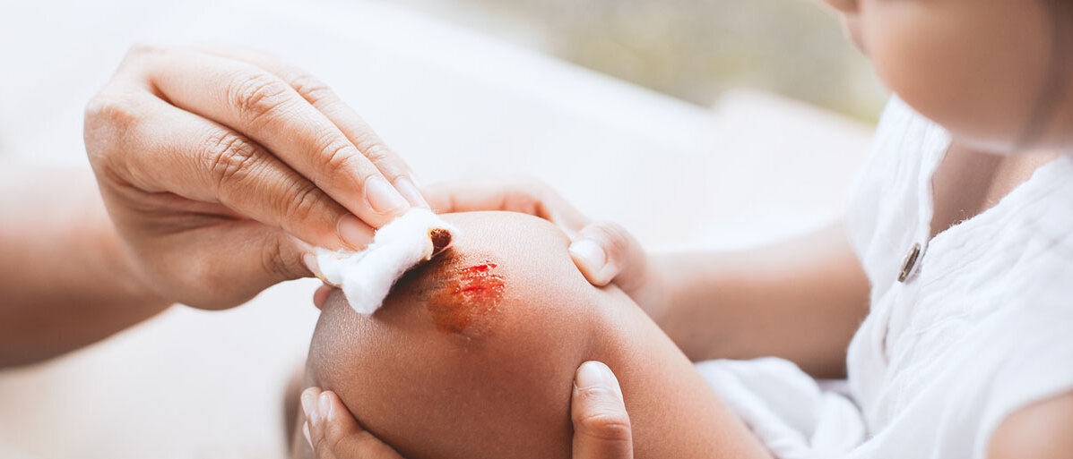 Schürfwunden bei Kindern Elternteil hilft Kind bei der Säuberung einer Schürfwunde am Knie