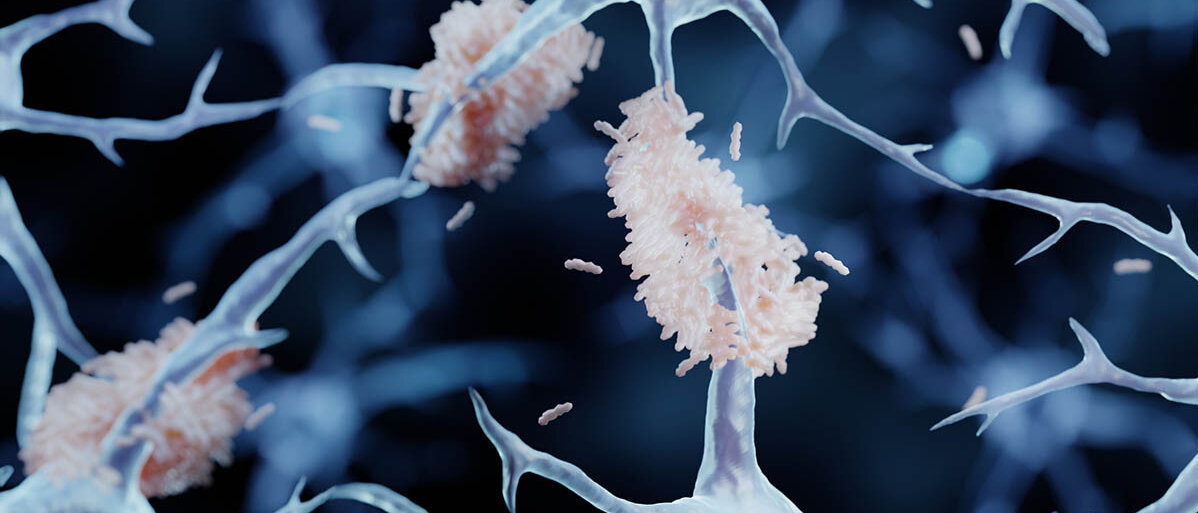 Nervenzellen, an deren Axone sich Anhäufungen aus einem anderen Material befinden.