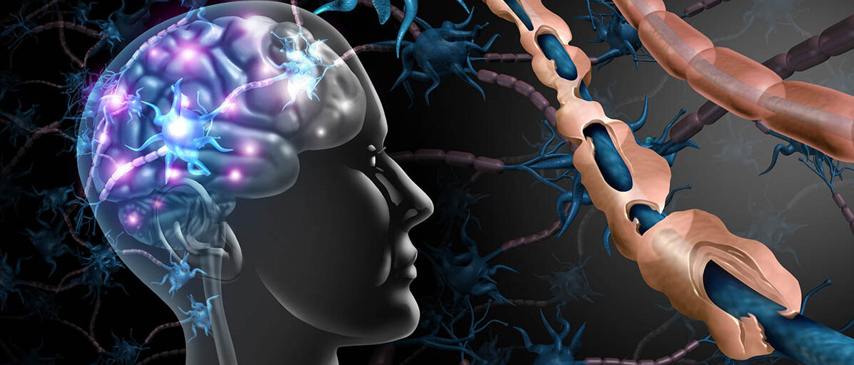 Neue Therapie bei Multipler Sklerose mit Tolebrutinib Darstellung zweier Nervenfasern: Eine hat inakte Myelinscheiden in regelmäßigen Abständen, bei der anderen sind die Myelinscheiden defekt.