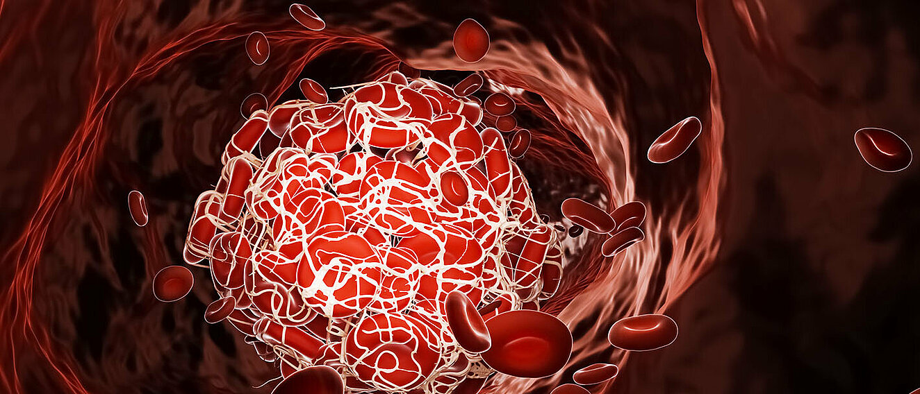 Thrombus in einem Blutgefaeß und rote Blutkoerperchen, die herumschwimmen