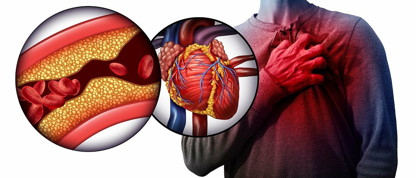Ein Mann greift sich an die Brust. In einem vergrößernden Kreis sieht man eine Darstellung des Herzens. In einem weiter vergrößernden Kreis ist eine Arterienverengung dargestellt.