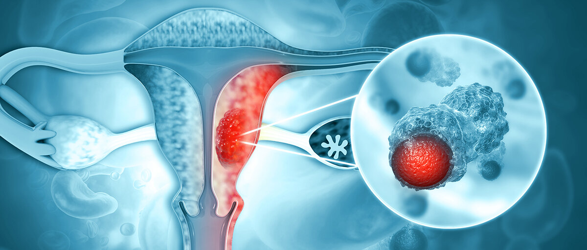 Eine schematische Darstellung des Gebärmutterhalses mit Krebszellen