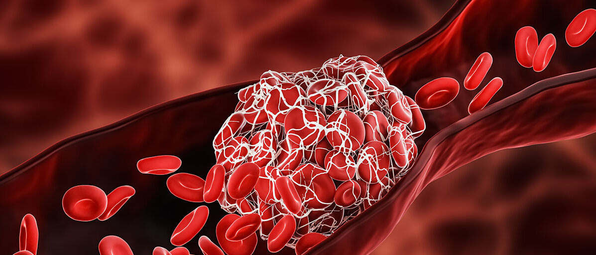 Blutgerinnsel, der die roten Blutkoerpchen in der Arterie blockiert