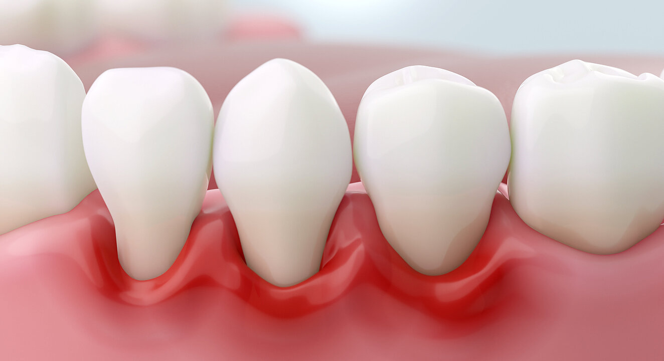 Illustration mehrerer Zähne. Der Zahnfleischrand an drei Zähnen ist rot und geschwollen.