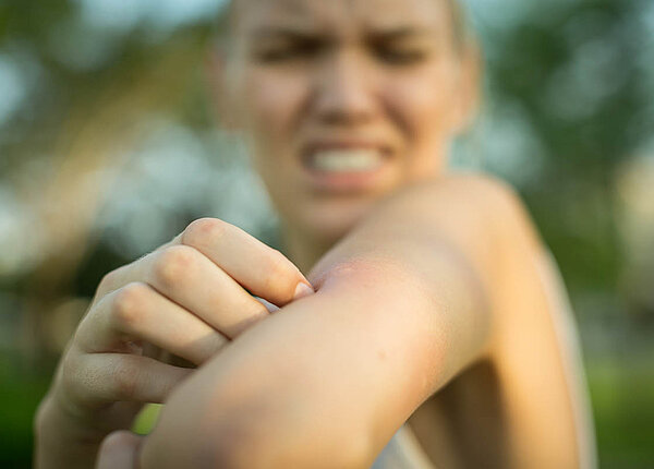 Eine Frau hat einen Insektenstich am Arm, verzerrt ihr Gesicht und kratzt am Stich.
